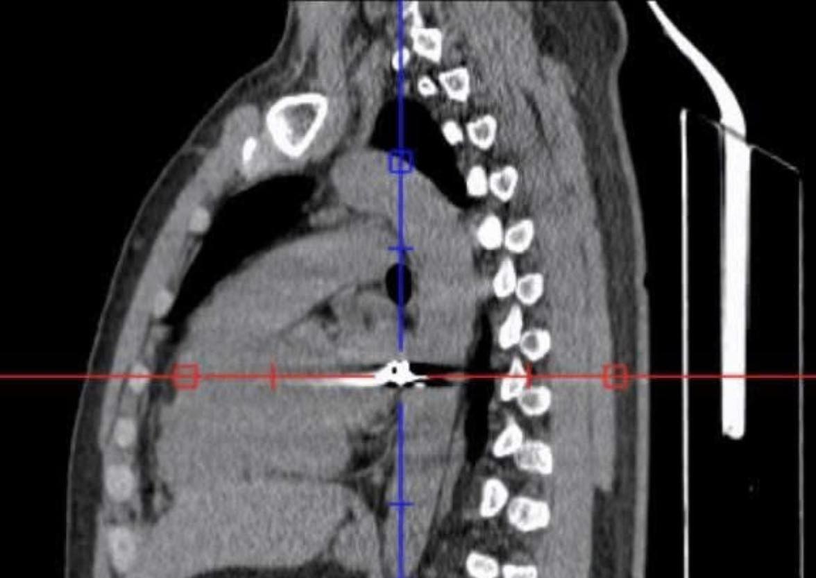 BỆNH VIỆN ĐA KHOA THỐNG NHẤT ĐỒNG NAI CỨU SỐNG BỆNH NHÂN BỊ ĐẠN BẮN XUYÊN NGỰC